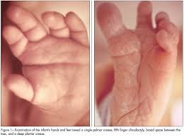 We did not find results for: Neonate With Hypotonia And Subtle Anomalies Consultant360