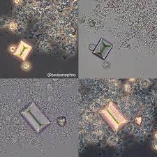 Triple Phosphate Crystals Amorphous Phosphates And Some Leucocytes In A Patient With A Chronic Urina Medical Laboratory Science Medical Laboratory Medical Tech
