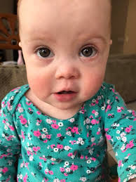 Will Nystagmus cause vision challenges in children?