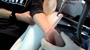 Patient comfort, safety and discretion is our priority, where we strive to always deliver and maintain the highest standards in patient care. Laser Tattoo Removal Cork Youtube