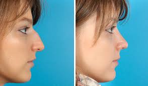 At that time, the average cost for the procedure in the united states was $5,125; Rhinoplasty Toronto Nose Job Cost Ontario Dr Asaria