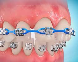 Braces not only fill the gap but they also make sure that your teeth are in perfect shape. Why Are My Braces Having Trouble Closing The Spaces Between My Teeth Affordable Braces Jorgensen Orthodontics