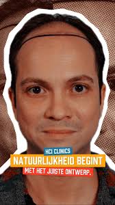 De ervaring van Timothy na 4 maanden. Timothy's experience after 4 months.  . . . . . #haartransplantatie #haartransplantatienederland  #haartransplantatieinnederland #haartransplantatieutrecht  #haartransplantatierotterdam #haartransplantatieamsterdam ...