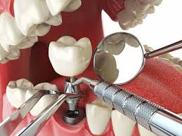 Image result for dental implant