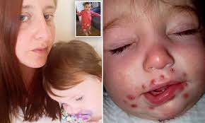 Babies born to infected mothers can be exposed to the virus during the. Mother Reveals Her Baby Girl Was Left Unable To Eat Or Drink After Catching Herpes From A Kiss Daily Mail Online