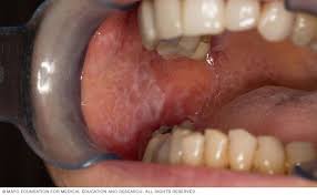 Image result for lichen planus on tongue)