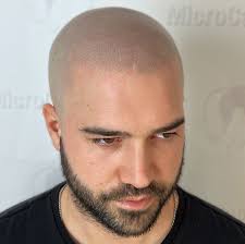 SWIPE LEFT ⬅️ BEFORE PICTURE Bring back your confidence with SCALP  MICROPIGMENTATION Instant, natural & long-lasting results... A quick,  effective solution ! NO surgery & NO complicated maintenance... Choose your  look: Natural