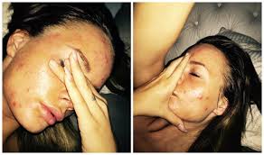 Men du vil lære de mest effektive metodene for å bekjempe hvis du har prøvd pillene, har du definitivt prøvd feil. Sophie Elise Hvordan Jeg Fikk Fin Hud Igjen