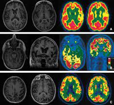 As with other types of aphasia, the symptoms that accompany ppa depend on what parts of the left hemisphere are significantly damaged. Afasia Primaria Progressiva Sciencedirect