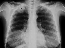 People who smoke have the greatest risk of lung cancer, though lung cancer can also occur in lung cancer often spreads (metastasizes) to other parts of the body, such as the brain and the begin conversations about the dangers of smoking with your children early so that they know how to. Pancoast Syndrome Risk Factors Symptoms And More