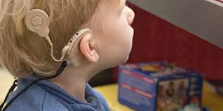 Image result for Cochlear Implant