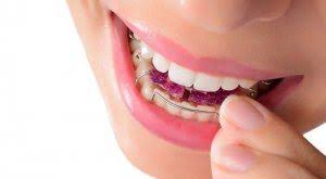Questo problema è stato risolto dalle mascherine per raddrizzare i denti: Apparecchio Di Contenzione Cos E Tipologie E Funzioni