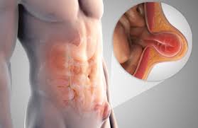 The internal male … pictures of male anatomy groin area. Men S Health Issues Hernias Groin Lumps Advanced Urology