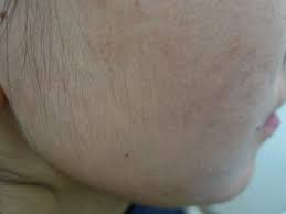 See a gp if it's a problem for you. Acd A Z Of Skin Hirsutism