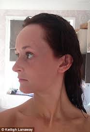 How do i make my forehead look smaller? Kent Woman Bullied For Large Forehead Got 6 500 Surgery Daily Mail Online