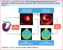 Myocardial Inflammation Predicts Remodeling And Neuroinflammation After Myocardial Infarction Sciencedirect