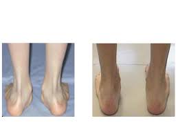 Der knicksenkfuß, diagnose und möglichkeiten in der therapie. Behandlung Von Knicksenkfuss Und Plattfuss