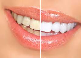 How Does Professional Teeth Whitening Work? | Dr. Rick Dentistry