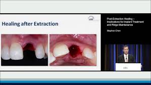 During the healing process, the gap where your. Post Extraction Healing Implications For Implant Treatment And Ridge Maintenance Stephen Chen Youtube