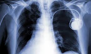 Warning Pacemakers Could Be Hacked Putting Lives At Risk Cardiology Medical Cardiac