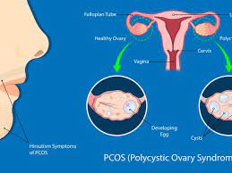 Pcos is one of the most common causes of female infertility, affecting 6% to 12% (as many as 5 million) of us women of reproductive age. Apa Penyebab Pcos Dan Bagaimana Cara Mengatasi Pcos