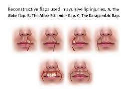 It borrows tissue from one lip to reconstruct the deficient lip. Management Of Soft Tissue Injuries By A M