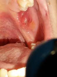 Manchmal stärker, dann kann ich meine zähne nicht aufeinander setzen, ohne dass es echt weh tut, aber manchmal geht es auch gerade noch so, dass der zahn nur daran reibt. Entzundung Wange Gebissen Gesundheit Schmerzen Zahnarzt