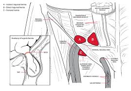 Inguinal hernias happen when the open lining does not close before birth. Racgp General Practitioner Primer On Groin Hernias