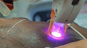 Laser hair removal penetrates the skin and destroys or damages individual hair follicles. Hair Removal Magic What Black Women Need To Know About Laser Hair Removal Mdhairmixtress Com