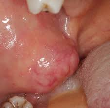 Image result for Labial mucosa