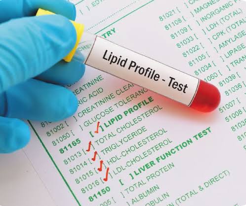 Lipid Profile Test product image