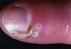 Image result for paronychium