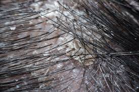 Image result for white scabs on the head in children