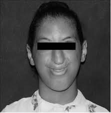 Long-term survival after corrective surgeries in two patients with severe  deformities due to Roberts syndrome: A Case report and review of the  literature.