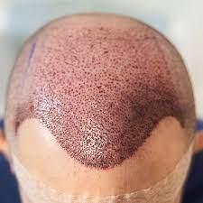 A complete guide for hair re-growth after a Hair transplant? - Hair  Transplant | Looksstudio | Blog