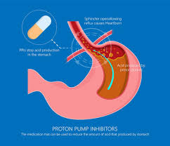 Acid reflux and GERD treatment