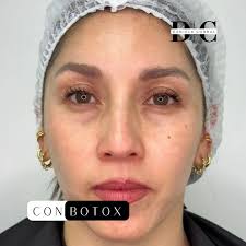 Dani nos tienes aburrida con Botox! 👭Jaja si lo sé! Pero es que yo no paro  de impresionarme y de amar sus resultados! 💉✨ Definitivamente un MUST de  tu rutina de cuidados