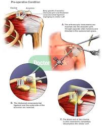 Left Shoulder Impingement Syndrome With Arthroscopic Surgical Decompression Doctor St Shoulder Impingement Syndrome Impingement Syndrome Shoulder Impingement