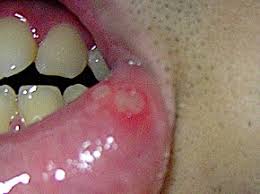 Take a look at canker sore pictures to help identify what a canker sore looks like in the mouth, on the lip, on the gums and on the tongue. Aphthous Stomatitis Wikipedia