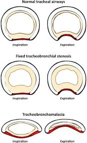 Image result for Relapsing Polychondritis