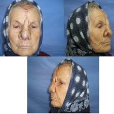 Patient aspect after 2 weeks