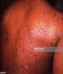 Image result for Neurosyphilis