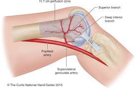 According to the hospital for special surgery, the medial femoral condyle is the inside of the knee, and health issues dealing with it can be treated. Lateral Femoral Condyle Flap An Alternative Source Of Vascularized Bone From The Distal Femur Sciencedirect