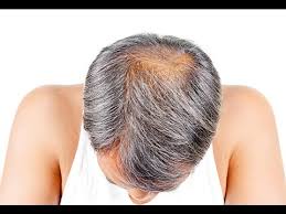 You can try head massages and masks using different types of oils. How To Stop Baldness And Regrow Hair Naturally Fast Hair Loss Treatment Youtube