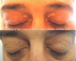 How is xanthelasma treated and removed? Xanthelasma Services In Lake Town Kolkata Id 17081101348