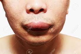 The Skin Around The Mouth Caused By An Allergic Reaction To Medication Stock Photo Picture And Royalty Free Image Image 56264609