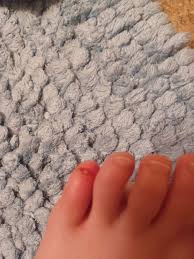 Image result for Onychotillomania feet