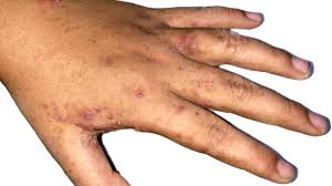 Image result for mite bites on humans