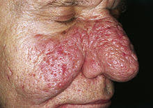 Behandlung der papulopustulosen rosazea der frau mit zyproteronazetat. Rosazea Wikipedia