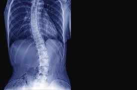 If you've been through the comments in my other blog posts regarding fixing your posture, you will already know that i find this. Can You Reverse Your Scoliosis Mile High Spine Pain Center